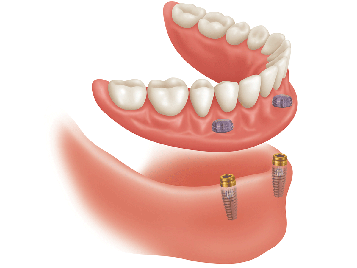 Dentures Gold Coast Dentures Clinic
